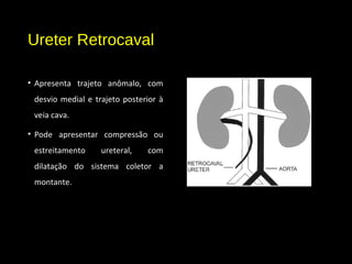 Ureter Retrocaval
• Apresenta trajeto anômalo, com
desvio medial e trajeto posterior à
veia cava.
• Pode apresentar compressão ou
estreitamento ureteral, com
dilatação do sistema coletor a
montante.
 