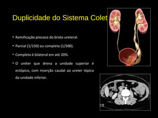 Duplicidade do Sistema Coletor
• Ramificação precoce do broto ureteral.
• Parcial (1/150) ou completa (1/500).
• Completa é bilateral em até 20%.
• O ureter que drena a unidade superior é
ectópico, com inserção caudal ao ureter tópico
da unidade inferior.
 