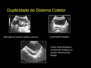 Duplicidade do Sistema Coletor
Dilatação do sistema coletor superior Ureterocele Ectópica
Ureter distal dilatado e
ureterocele ectópico na
porção intramural da
bexiga
 