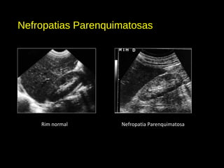 Nefropatias Parenquimatosas
Rim normal Nefropatia Parenquimatosa
 