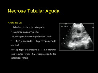 Necrose Tubular Aguda
• Achados US:
• Achados clássicos da nefropatia.
• Isquemia: rins normais ou
hipoecogenicidade das pirâmides renais.
• Nefrotoxicidade: hiperecogenicidade
cortical.
•Precipitação de proteína de Tamm Horsfall
nos túbulos renais – hiperecogenicidade das
pirâmides renais.
 