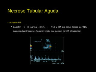 Necrose Tubular Aguda
• Achados US:
• Doppler -  IR (normal < 0,75) - NTA x IRA pré-renal (Cerca de 91% -
exceção das síndromes hepatorrenais, que cursam com IR elevaodos).
 