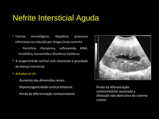 Nefrite Intersticial Aguda
• Fatores imunológicos, idiopática, processos
infecciosos ou induzida por drogas (mais comum).
- Penicilina, rifampicina, sulfonamida, AINH,
cimetidina, furosemida e diuréticos tiazídicos.
• A ecogenicidade cortical está relacionda à gravidade
da doença intersticial.
• Achados ao US:
-Aumento das dimensões renais.
-Hiperecogenicidade cortical bilateral.
-Perda da diferenciação corticomedular
Perda da diferenciação
corticomedular associada a
dilatação não obstrutiva do sistema
coletor
 