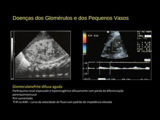 Doenças dos Glomérulos e dos Pequenos Vasos
Glomerulonefrite difusa aguda
Parênquima renal espessado e hiperecogênico difusamente com perda da diferenciação
parenquimosinusal
Rim aumentado
↑IR na AIM – curva da velocidade de fluxo com padrão de impedância elevada
 