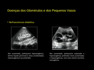 Doenças dos Glomérulos e dos Pequenos Vasos
• Nefroesclerose diabética
Rim aumentado, parênquima hiperecogênico,
lâmina líquida perirrenal e áreas arredondadas
hiperecogênicas nas pirâmides.
Rim aumentado, parênquima espessado e
hiperecogênico, pirâmides renais aumentadas
e hipoecogênicas, com área central necrótica
anecogênica.
 