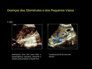 Doenças dos Glomérulos e dos Pequenos Vasos
• LES
Parênquima renal com áreas hiper e
hipoecogênicas esparasas, alterando a
relação corticomedular e líquido livre
Trombose parcial da veia cava
inferior
 
