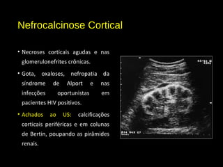 Nefrocalcinose Cortical
• Necroses corticais agudas e nas
glomerulonefrites crônicas.
• Gota, oxaloses, nefropatia da
síndrome de Alport e nas
infecções oportunistas em
pacientes HIV positivos.
• Achados ao US: calcificações
corticais periféricas e em colunas
de Bertin, poupando as pirâmides
renais.
 