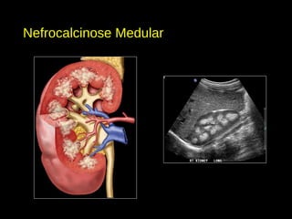 Nefrocalcinose Medular
 