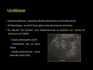Urolitíase
• Quadros dolorosos – pesquisar cálculos obstrutivos ou semi-obstrutivos.
• A hidronefrose : em até 6 horas após o início do processo obstrutivo.
• Os cálculos “em trânsito” mais frequentemente se localizam nos “pontos de
estreitamento” (95%):
- Junção ureteropiélica (JUP).
- Cruzamento com os vasos
ilíacos.
- Junção ureterovesical – terço
distal do ureter (JUV).
 