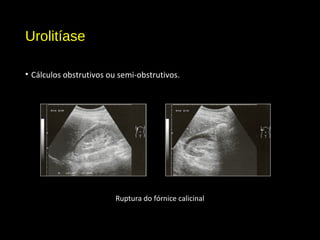 Urolitíase
• Cálculos obstrutivos ou semi-obstrutivos.
Ruptura do fórnice calicinal
 