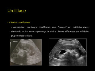 Urolitíase
• Cálculos coraliformes
- Apresentam morfologia coraliforme, com “pontas” em múltiplos eixos,
simulando muitas vezes a presença de vários cálculos diferentes em múltiplos
grupamentos caliciais.
 