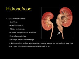 Hidronefrose
• Pesquisa fator etiológico:
- Urolitíase.
- Estenose ureteral.
- Fibrose periureteral.
- Tumores retroperitoneais e pélvicos .
- Anomalias congênitas.
- Patologias e disfunções da bexiga.
- Não-obstrutivas: refluxo vesicoureteral, quadro residual de hidronefrose pregressa
prolongada e doenças inflamatórias, como a tuberculose.
 