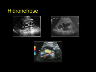 Hidronefrose
 