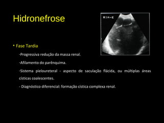 Hidronefrose
• Fase Tardia
-Progressiva redução da massa renal.
-Afilamento do parênquima.
-Sistema pieloureteral - aspecto de saculação flácida, ou múltiplas áreas
císticas coalescentes.
- Diagnóstico diferencial: formação cística complexa renal.
 