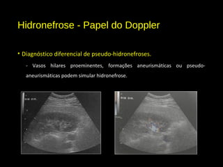 Hidronefrose - Papel do Doppler
• Diagnóstico diferencial de pseudo-hidronefroses.
- Vasos hilares proeminentes, formações aneurismáticas ou pseudo-
aneurismáticas podem simular hidronefrose.
 