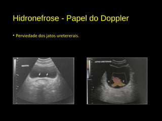 Hidronefrose - Papel do Doppler
• Perviedade dos jatos uretererais.
 