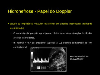 Hidronefrose - Papel do Doppler
• Estudo da impedância vascular intra-renal em artérias interlobares (reduzida
sensibilidade).
- O aumento da pressão no sistema coletor determina elevação do IR das
artérias interlobares.
- IR normal < 0,7 ou gradiente superior a 0,1 quando comparado ao rim
contralateral.
Obstrução crônica –
IR da AIM 0,77
 