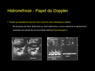 Hidronefrose - Papel do Doppler
• Estudo da impedância vascular intra-renal em veias interlobares médias.
- Na presença de fator obstrutivo ou semi-obstrutivo, a curva espectral se apresentará
achatada com perda da sua fasicidade habitual (“portalização”).
 