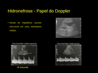 Hidronefrose - Papel do Doppler
• Estudo da impedância vascular
intra-renal em veias interlobares
médias.
IR reduzido
Veia interlobar média esquerda Veia interlobar média direita
 
