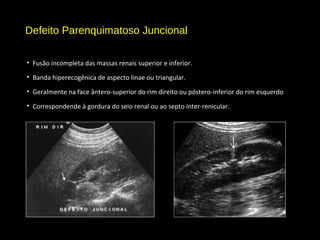 Defeito Parenquimatoso Juncional
• Fusão incompleta das massas renais superior e inferior.
• Banda hiperecogênica de aspecto linae ou triangular.
• Geralmente na face ântero-superior do rim direito ou póstero-inferior do rim esquerdo
• Correspondende à gordura do seio renal ou ao septo inter-renicular.
 