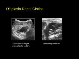 Displasia Renal Cística
Dolicomegaureter a EAcentuada dilatação
pielocalicial e ureteral
 