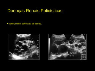Doenças Renais Policísticas
• Doença renal policística do adulto.
 