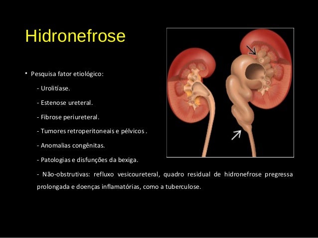 Ultrassom do rim