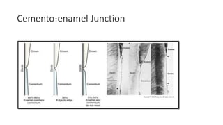 Cemento-enamel Junction
 
