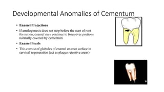 Developmental Anomalies of Cementum
• Enamel Projections
• If amelogenesis does not stop before the start of root
formation, enamel may continue to form over portions
normally covered by cementum
• Enamel Pearls
• This consist of globules of enamel on root surface in
cervical regeneration (act as plaque retentive areas)
 