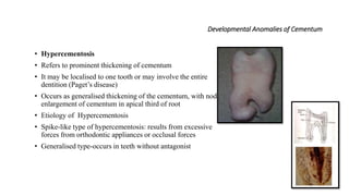 Developmental Anomalies of Cementum
• Hypercementosis
• Refers to prominent thickening of cementum
• It may be localised to one tooth or may involve the entire
dentition (Paget’s disease)
• Occurs as generalised thickening of the cementum, with nodular
enlargement of cementum in apical third of root
• Etiology of Hypercementosis
• Spike-like type of hypercementosis: results from excessive
forces from orthodontic appliances or occlusal forces
• Generalised type-occurs in teeth without antagonist
 