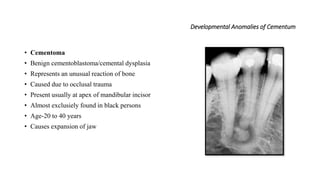 Developmental Anomalies of Cementum
• Cementoma
• Benign cementoblastoma/cemental dysplasia
• Represents an unusual reaction of bone
• Caused due to occlusal trauma
• Present usually at apex of mandibular incisor
• Almost exclusiely found in black persons
• Age-20 to 40 years
• Causes expansion of jaw
 