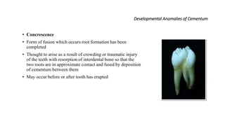 Developmental Anomalies of Cementum
• Concrescence
• Form of fusion which occurs root formation has been
completed
• Thought to arise as a result of crowding or traumatic injury
of the teeth with resorption of interdental bone so that the
two roots are in approximate contact and fused by deposition
of cementum between them
• May occur before or after tooth has erupted
 