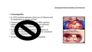 Developmental Anomalies of Cementum
• Cementopathia
• In 1923, Gottlieb reported a fatal case of influenza and
he attributed it as atrophy of bone
• Characterised by loss of collagen in PDL and their
replacement by loose connective tissues and bone
resorption resulting in widened PDL space
• Gottlieb attributed this condition to inhibition of
continuous cementum formation which he considered
essential for cementum formation
• He then termed the disease as cementopathia
 
