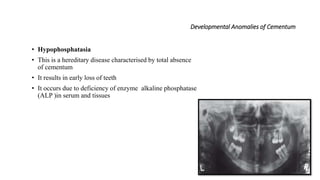 Developmental Anomalies of Cementum
• Hypophosphatasia
• This is a hereditary disease characterised by total absence
of cementum
• It results in early loss of teeth
• It occurs due to deficiency of enzyme alkaline phosphatase
(ALP )in serum and tissues
 