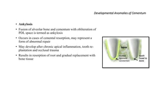 Developmental Anomalies of Cementum
• Ankylosis
• Fusion of alveolar bone and cementum with obliteration of
PDL space is termed as ankylosis
• Occurs in cases of cemental resorption, may represent a
form of abnormal repair
• May develop after chronic apical inflammation, tooth re-
plantation and occlusal trauma
• Results in resorption of root and gradual replacement with
bone tissue
 