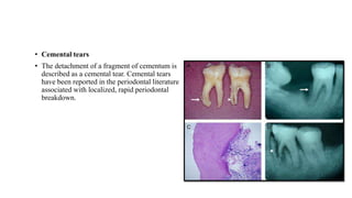 • Cemental tears
• The detachment of a fragment of cementum is
described as a cemental tear. Cemental tears
have been reported in the periodontal literature
associated with localized, rapid periodontal
breakdown.
 