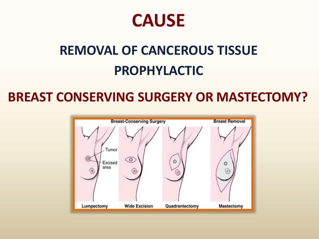 Mastectomy and Breast Cancer