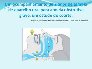 Um acompanhamento de 2 anos de terapia
de aparelho oral para apneia obstrutiva
grave: um estudo de coorte.
Haviv Y1, Bachar G, Aframian DJ Almoznino G, E Michaeli, R. Benoliel
 