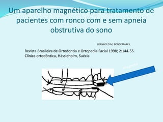 Um aparelho magnético para tratamento de
pacientes com ronco com e sem apneia
obstrutiva do sono
BERNHOLD M, BONDEMARK L.
Revista Brasileira de Ortodontia e Ortopedia Facial 1998; 2:144-55.
Clínica ortodôntica, Hässleholm, Suécia
 