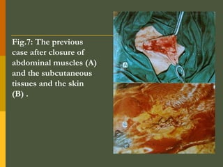 Fig.7: The previous
case after closure of
abdominal muscles (A)
and the subcutaneous
tissues and the skin
(B) .

 