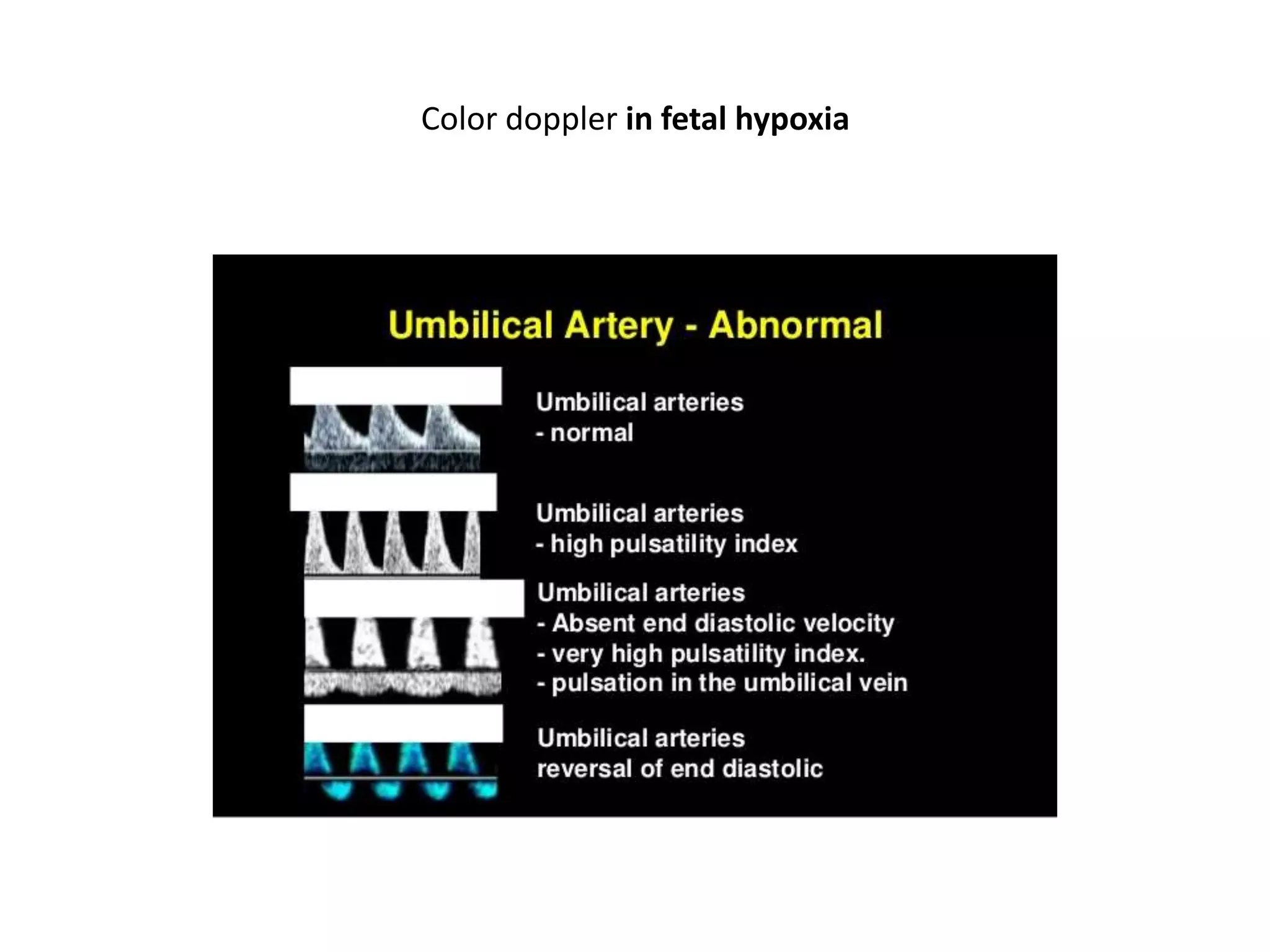 Umbilical artery doppler [1] | PPTX