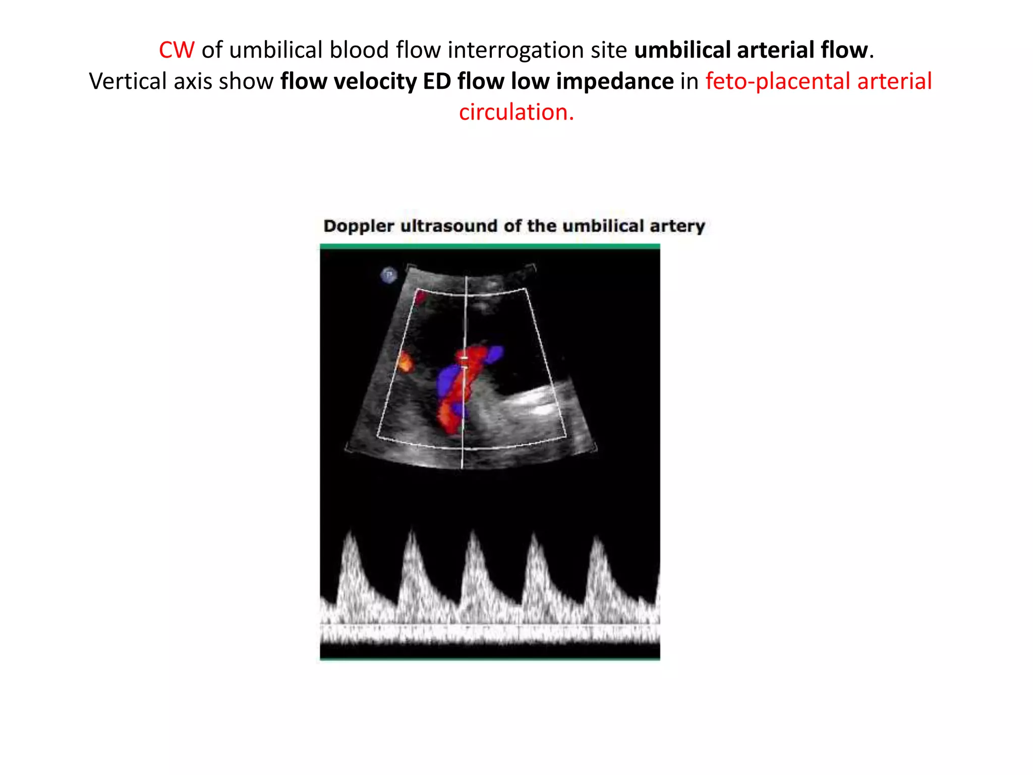 Umbilical artery doppler [1] | PPTX