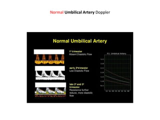 Normal Umbilical Artery Doppler
 