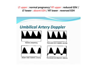 LT upper : normal pregnancy/ RT upper : reduced EDV /
LT lower : absent EDV / RT lower : reversed EDV
 