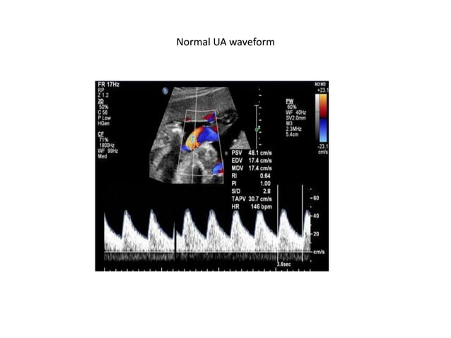 Umbilical artery doppler [1] | PPTX | Pregnancy | Reproductive Health