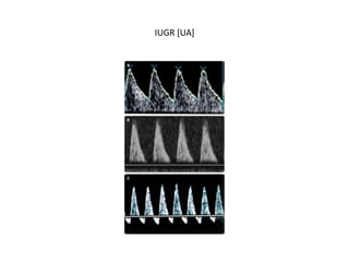 IUGR [UA]
 