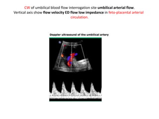 CW of umbilical blood flow interrogation site umbilical arterial flow.
Vertical axis show flow velocity ED flow low impedance in feto-placental arterial
circulation.
 