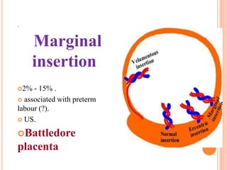 .
Marginal
insertion
2% - 15% .
 associated with preterm
labour (?).
 US.
Battledore
placenta
 