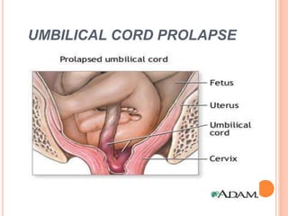 UMBILICAL CORD PROLAPSE
 