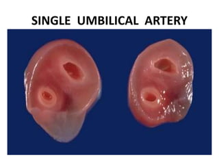 SINGLE UMBILICAL ARTERY
 